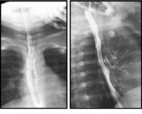 Figure 3 From Acquired Tracheoesophageal Fistula Following Disc Battery