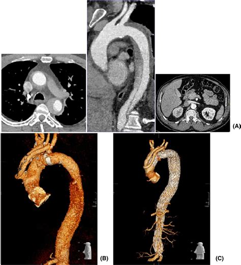 CT aortic angiogram. (A) Type B aortic dissection extending to the ...