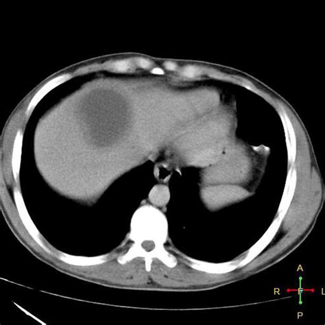 Amebic Liver Abscess Pathology