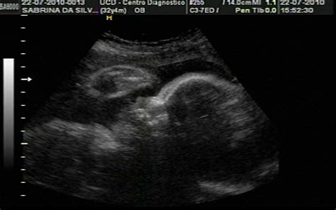 Feto De 3 Meses Ultrassom - Fotos De Ultrassom De 3 Meses
