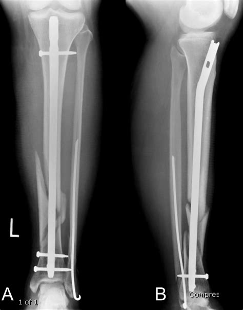 Medical Apparatus Imaging Guide Fracture Fixation