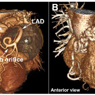 Anterior Views Of Perioperative Three Dimensional Volume Rendered CTA