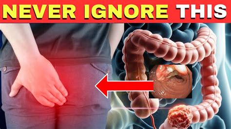 Critical Colon Cancer Symptoms You Should Never Ignore Youtube