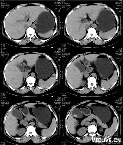 PHILIPS每日一例慢性胆囊炎并胆囊结石CT病例图片影像诊断分析 MedSci cn