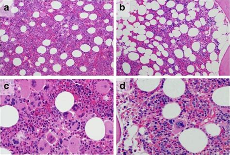 Myelofibrosis: Causes, Symptoms & Treatment Options