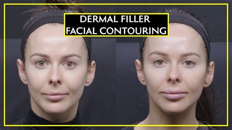 All About Facial Contouring With Dermal Fillers YouTube