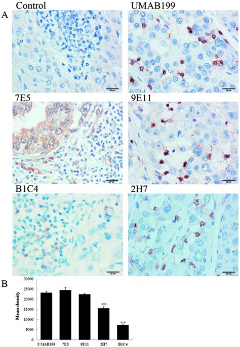 Expression And Clinical Significance Of Pd In Hepatocellular