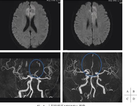 Figure From A Case Of Azygos Anterior Cerebral Artery Dissection With