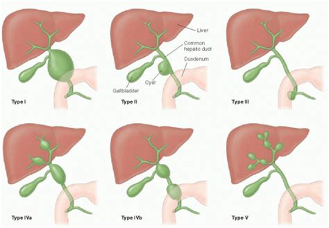 Choledochal Cysts Mnemonic For Todani Classification Epomedicine