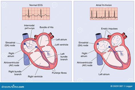 Normal Heart Electrical Conduction And Atrial Fibrillation Stock Vector Illustration Of