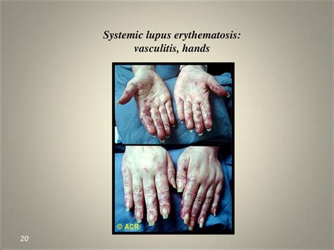 Systemic Lupus Erythematosus Ppt Download