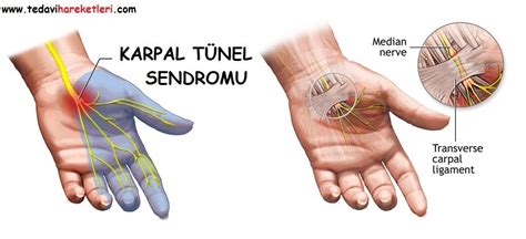 Karpal Tünel Sendromu