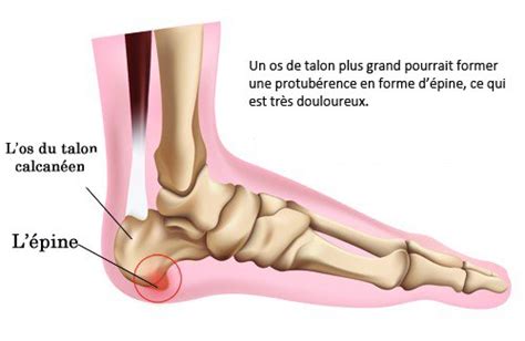 Epine Calcaneenne