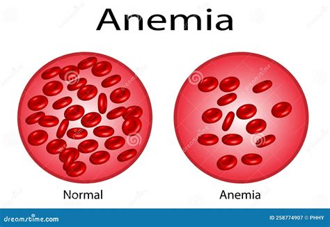 Iron Deficiency Anemia Realistic Vector 3d Picture Types Of Anemia Vector Illustration Stock