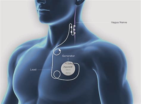 Figure From Vagus Nerve Stimulation For The Treatment Of Epilepsy