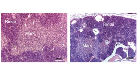 Krebs des Thymus Forschende klären den Ursprung einer seltenen