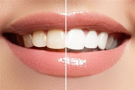 Teeth Whitening Facts Myths Village Green Dental Care