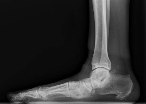 Flatfoot — Daniel Bohl, MD | Midwest Orthopaedics at RUSH