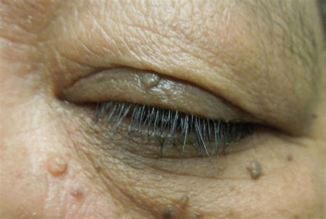 Moran Core Eyelid Masses