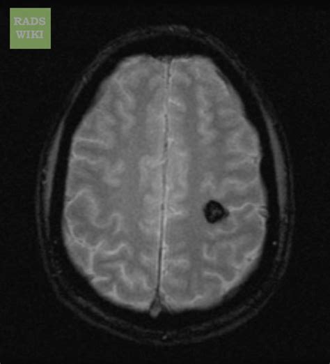 Cavernous angioma pathophysiology - wikidoc