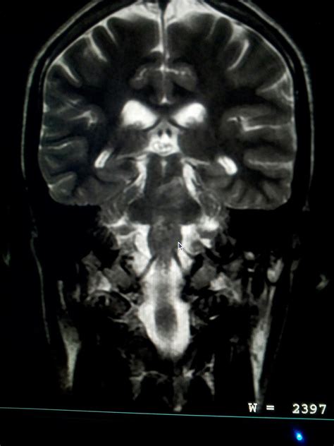 Radiodiagnóstico RMN Cerebral MAV