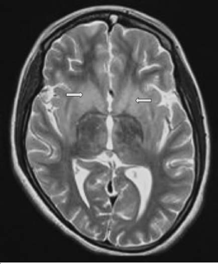 Magnetic Resonance Imaging T2 Weighted Image Showing Hyperintense Areas Download Scientific