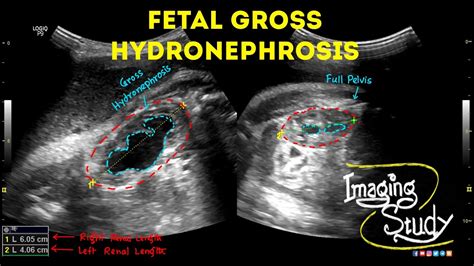 Fetal Hydronephrosis Ultrasound