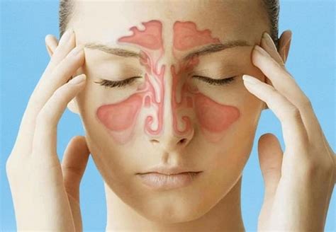 How To Prevent Sinus Infections Tips For Boosting Immunity