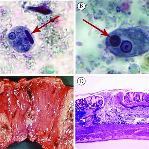 Entamoeba Histolytica Causes