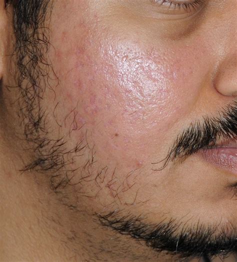 Acne Scar Treatment Before After Photos Seattle Bellevue