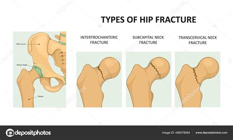 Types Of Hip Fracture Femoral Neck Fracture Medical Vector Illustration Stock Vector Image By