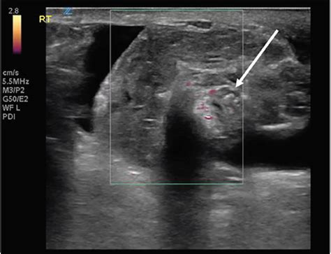 Testicular Pathology Ultrasound