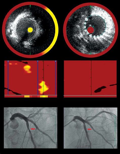 Panel A Reveals The Intravascular Ultrasound Ivus Image Of A Lesion