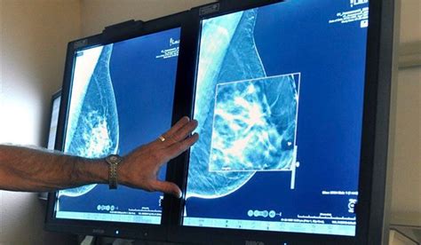 More Women May Need Breast Cancer Gene Test U S Guidelines National