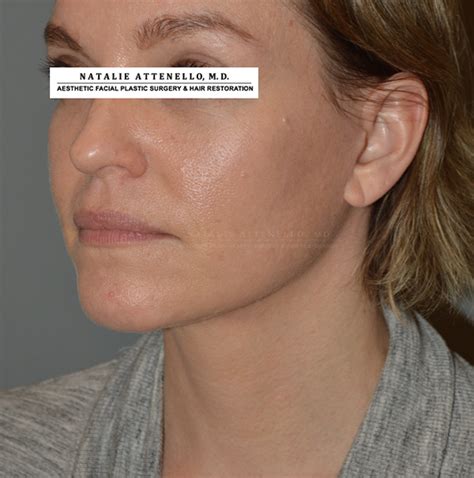 Beverly Hills Facelift Before And After Photos Los Angeles Plastic