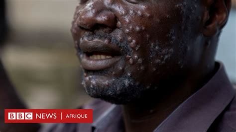 Mpox La Variole Du Singe D Clar E Urgence Sanitaire En Afrique Que