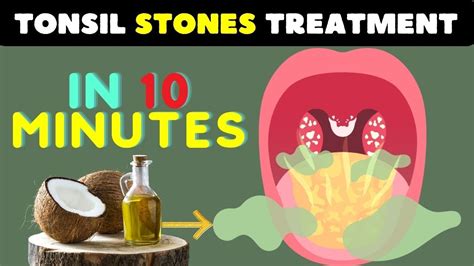 How To Remove Tonsil Stones 10 Powerful Home Remedies For Tonsil Stones Relief Youtube