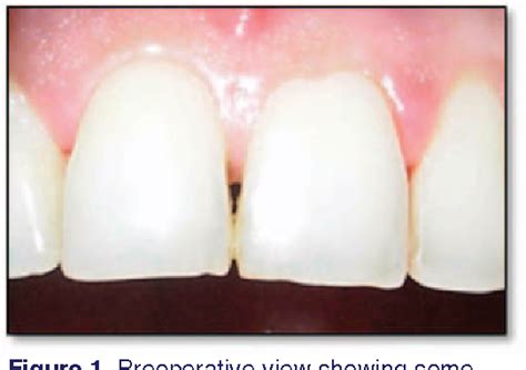 Surgical Reconstruction Of Interdental Papilla Using Subepithelial