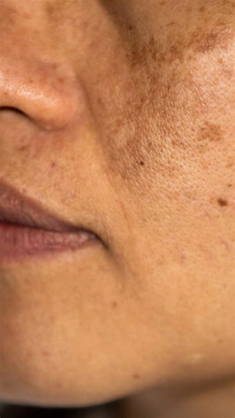 झुर्रियां झांई और Pimples से छुटकारा पाने के लिए चेहरे पर इस तरह लगाएं