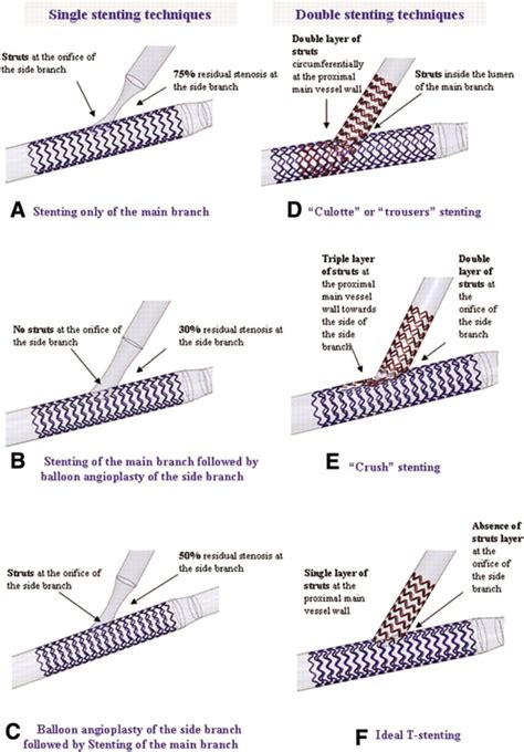 Flow Patterns At Stented Coronary Bifurcations Circulation