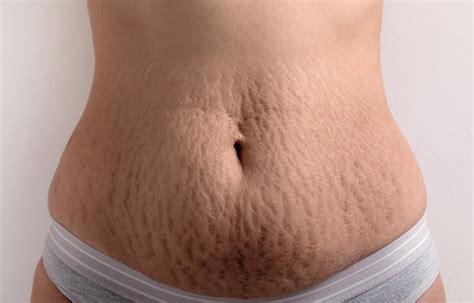 Stretch Marks Causes Prevention And Treatment Newu Wellness