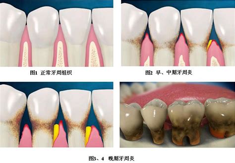 口腔科普牙周病科常见疾病的介绍及预防 口腔科普 中山市口腔医院 厚德 济齿 精诚 创新 中山市口腔医院 厚德 济齿 精诚 创新