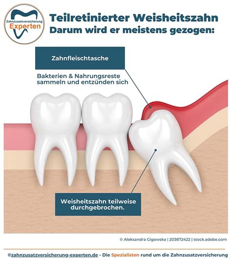 Weisheitszahn OP Dauer Ablauf Narkose Co