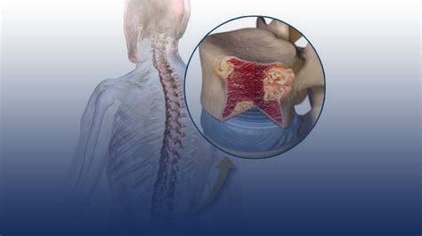 Bone Marrow Transplant for Multiple Myeloma | Home