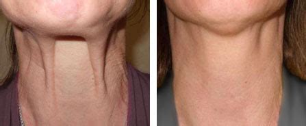 Jowl Tightening Nefertiti Lift Treatment Neck Fillers Milo Clinic