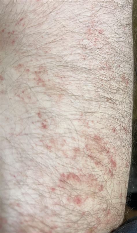 Rash Thats Been Spreading The Last Few Weeks Trying To Figure Out