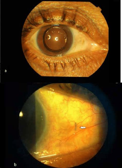 A Postoperative Picture Of Scleral Fixated Intraocular Lens B Tucked