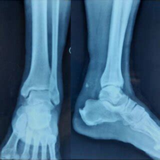 X-ray of the left foot showing an avulsion fracture of the calcaneal ...