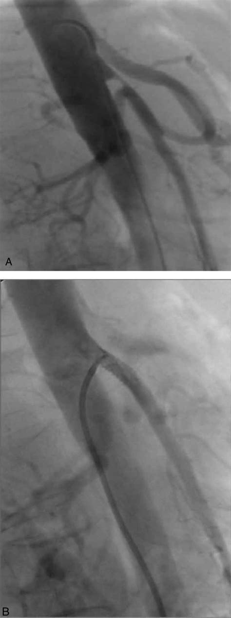 A Lateral Aortography In A Woman Shows High Grade Sma Stenosis White Download Scientific