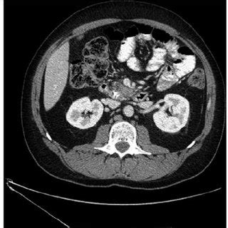 Followup Contrastenhanced Computed Tomography Scan Per Formed After